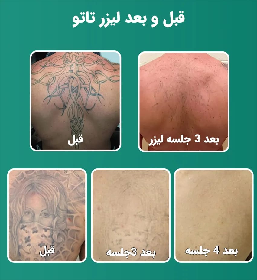 بهترین خدمات پاک کردن تاتو با دستگاه لیزر کیو سوایچ زیر نظر پزشک در کرج