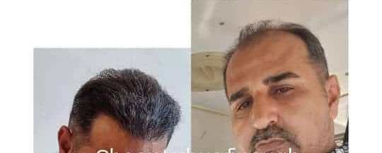 بهترین مرکز کاشت مو و ابرو در تهران