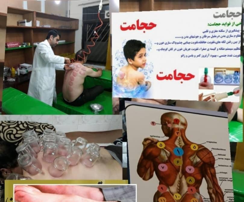 بهترین زالو درمانی و حجامت باکادری مجرب و متخصص در زاهدان