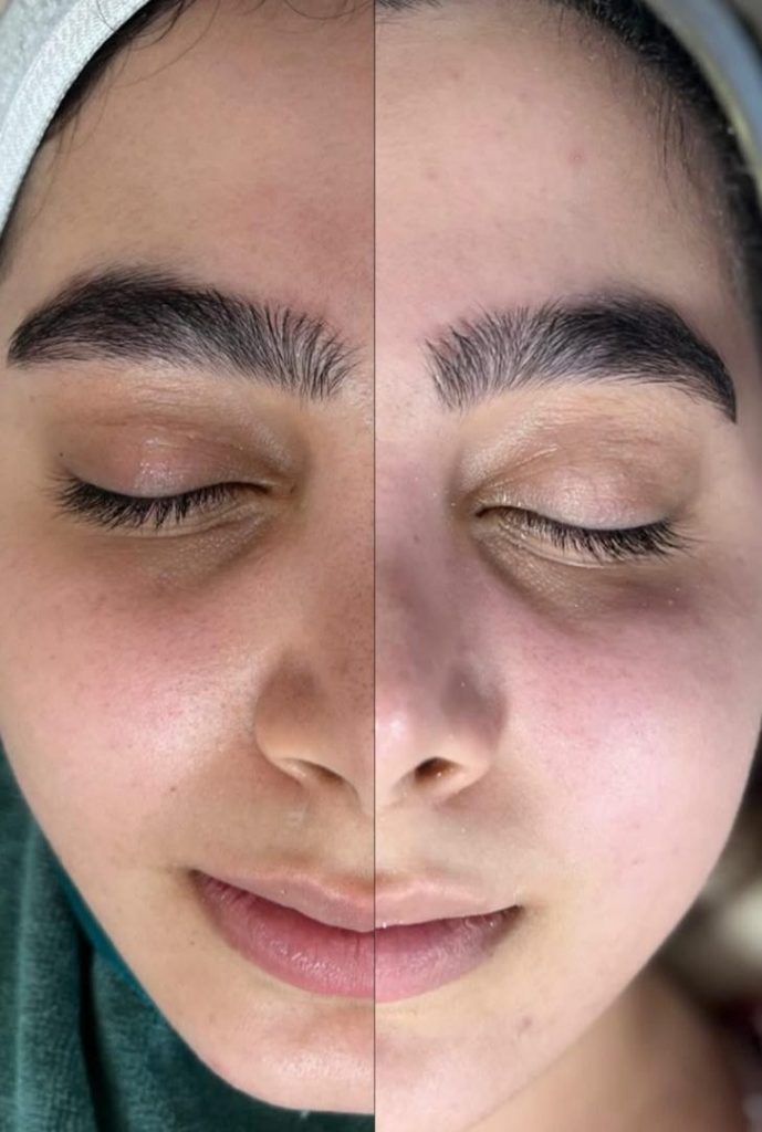 بهترین خدمات فیشال و پاکسازی پوست با هانا در شیراز