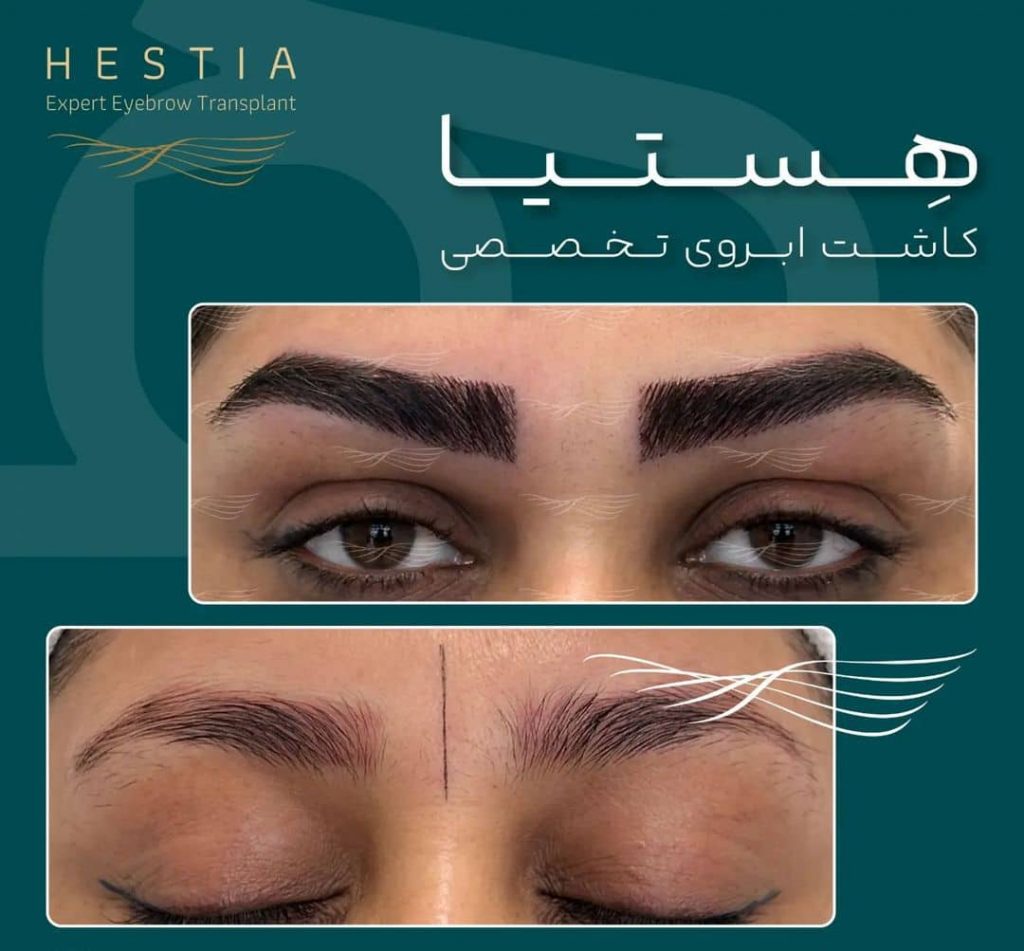 بهترین مرکز کاشت ابرو تخصصی هستیا در شیراز