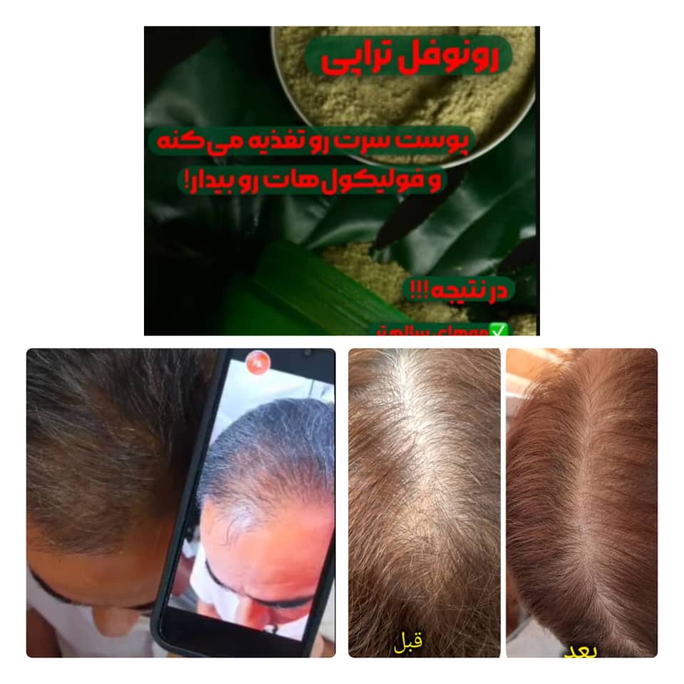 بهترین کلینیک تخصصی احیا ریشه مو و درمان ریزش مو با جدیدترین متد روز رونوفل تراپی صدرصد تضمینی در شیراز