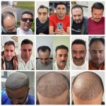 کلینیک شریف – بهترین کلینیک فوق تخصصی کاشت حرفه ای مو و ابرو در تبریز