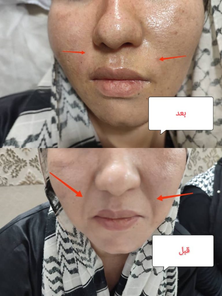 بهترین مرکز خدمات پوست و مو – فشیال جوانسازی لیزر خال در شهرری
